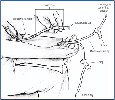 example of prone position of surgical procedures